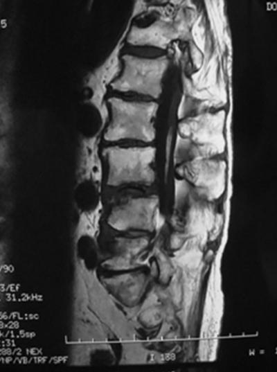 Figure 10 CASE 3. MALE 76 Y.O. ; ACUTE SEVERE LOW BACK PAIN He presented with the acute low back pain.