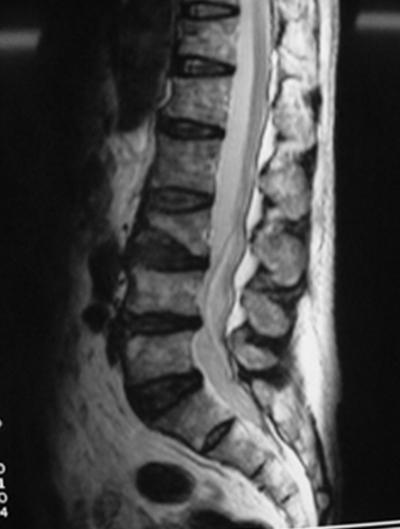 Figure 14 Figure 16 DISCUSSION Figure 15 7 of 9 Tethered Cord Syndrome (TCS) is commonly seen in childhood associated with diastematomyelia and myelomeningocele derived from the tethering of filum