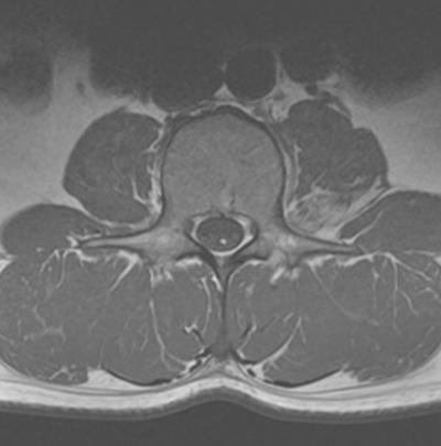 TCS is diagnosed with clinical symptoms with fatty filum terminale or lipoma in thecal sac that are demonstrated on MRI in more than 90%. On the other hand fatty filum terminale was found in 0.24-1.