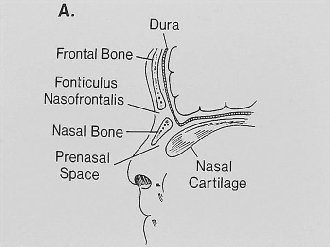 Embryology of Cranial DST Failure