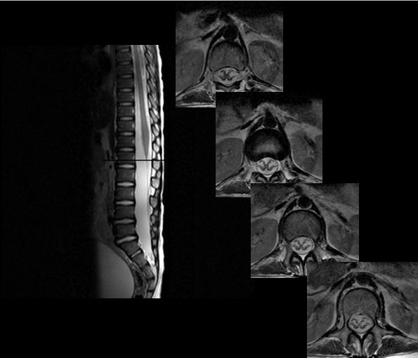 L1 2 3 4 5 S1 Level of Normal Conus Medullaris 100 children with brain tumors having screening whole spine imaging Level of conus medullaris measured Mode: L1-2 disc space Mean: Inferior third of L1