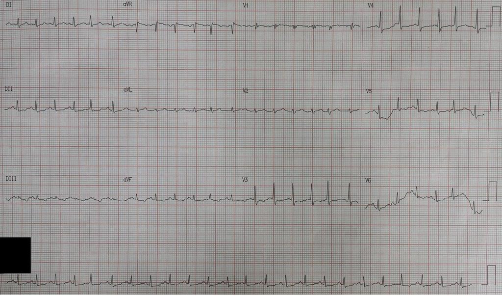 Fat Embolism: Figure 1 Sinus tachycardia with signs of overload of the right heart chambers (clockwise rotation with early transition in the precordial leads with R in V2) and secondary