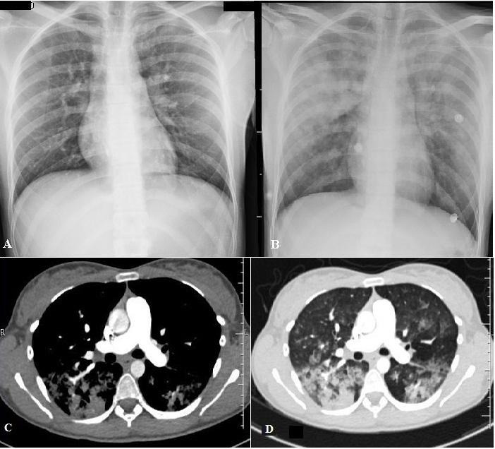 Fat Embolism: Figure 2 A) Chest X-ray on admission, normal. B) Radiography after 48 hours of evolution with the presence of diffuse alveolar infiltrate.