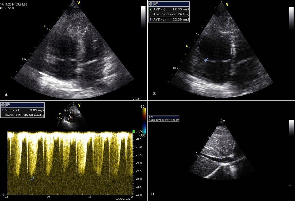 Fat Embolism: Figure 3 Transthoracic echocardiography: A) Increase of the right ventricle with normal left ventricle. B) Right ventricular systolic dysfunction with fractional area estimated at 24%.