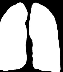 Tuberculosis: