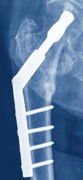 4 Prevention of cut-out: correct placement of the screw The correct placement of the DHS Screw or Blade has shown to be one of the main success factors to