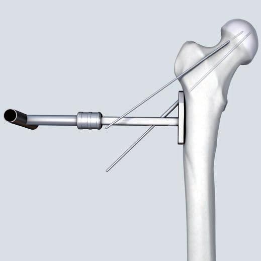 In the case of unstable fractures, insert several Kirschner wires into the femoral head to temporarily stabilize the reduced fragments. 6 Insert guide wire Instruments 338.000 DHS/DCS Guide Wire B 2.