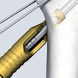Warning: To avoid damaging the instruments and the implant, tighten the connecting screw securely.
