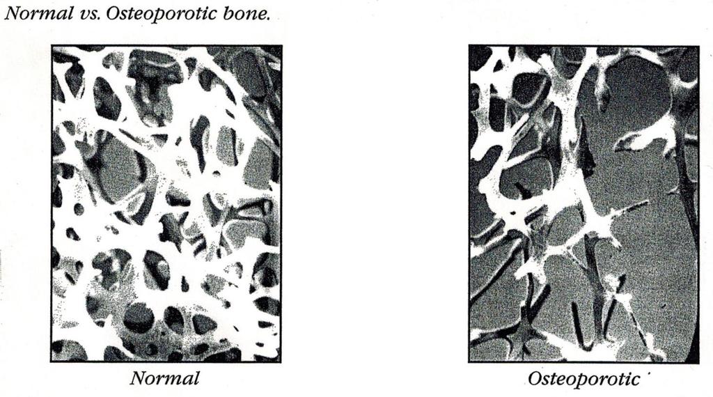 Fig.5. Osteoporotic bone versus normal bone. Reprint permission from Boning up on Osteoporosis A guide to prevention and treatment. National Osteoporosis Foundation 2009.