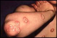 micrornas is expressed in human skin