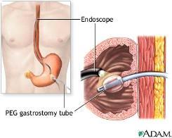 Choice of gastrostomy (G-tube), jejunostomy (J-tube) or gastrojejunostomy (G-J tube).