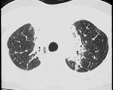 Traction Bronchiectasis Radiographic finding w/o clinical