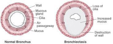 What is bronchiectasis Bronkos = Bronchi Ectasia = Dilatation