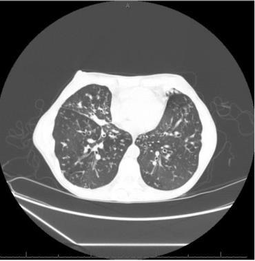 Radiographic features Bronchiectasis is diagnosed on axial images of chest CT based on: Internal diameter of