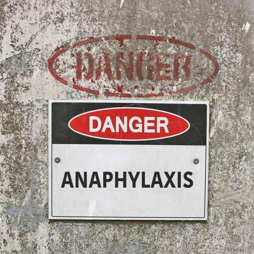 Allergic Reaction/Anaphylaxis Anaphylaxis o Sudden and rapid onset of severe symptoms o A reaction of an antigen and an antibody resulting in the release of histamine, causing the blood vessels to