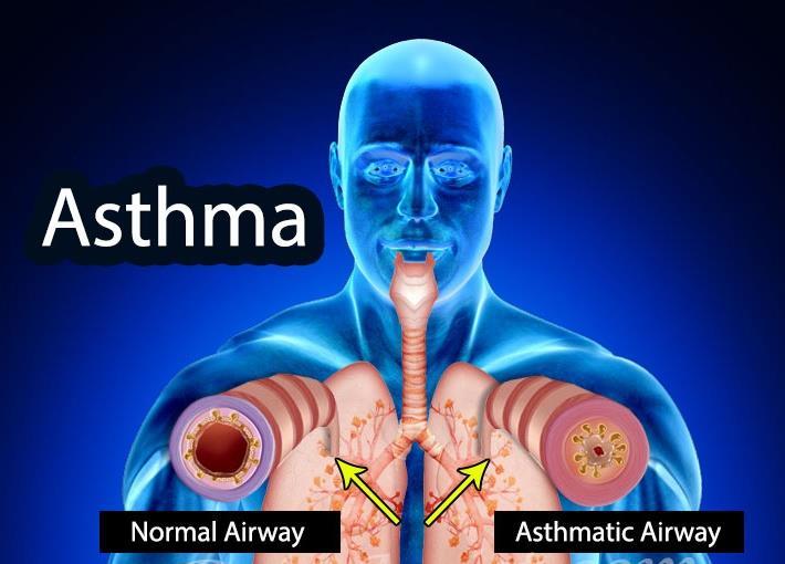 Asthma Causes,