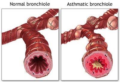 Asthma Asthma Pathophysiology o Increased tracheal and bronchial reactivity Causes