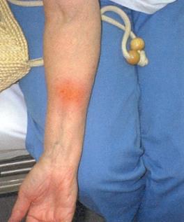 Allergic Reaction/Anaphylaxis Allergic Reaction Signs & Symptoms (slow onset) o Hives o Pruritus
