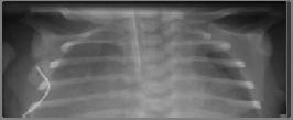 Ebstein s Anomaly CXR Truncus Arteriosus 3 Types. One great vessel arises from both ventricles with overriding VSD.