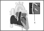Aortic Stenosis Critical Aortic Stenosis Obstruction of the valve can occur above the valve (supravalvular), at the aortic valve (valvular) or below the valve