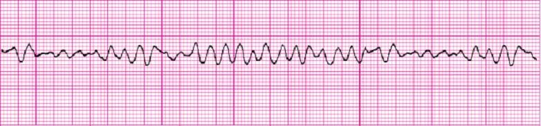 VENTRICULAR FIBRILLATION VFib is a chaotic and disorganized rhythm that generates absolutely no perfusion! The heart is quivering as it is dying and requires IMMEDIATE defibrillation do not delay!