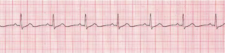 asystole. The most common are known as the H s & T s! As a team leader you should run through the list for consideration.