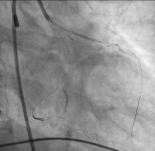 CASE - LM/LAD STENTING