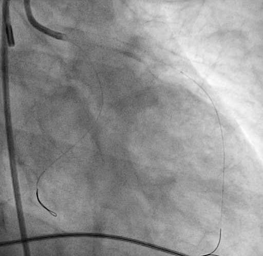 CASE - POST LAD STENTING