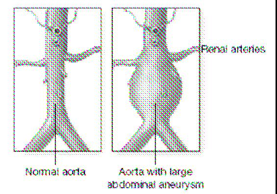 Abdominal Aortic Aneurysm David N.