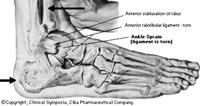Ankle MOI usually inversion Lateral sided injury Ankle: Differential DX Syndesmotic ankle sprain Fracture/ Growth plate injury Osteochondral fracture Tendon injury peroneal, posterior tibial,