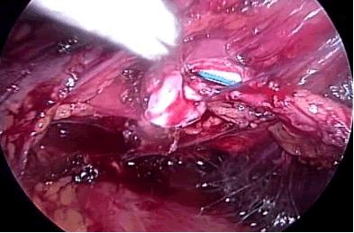 RESULTS Figure 1 Intraoperative view of end-to-side ureteropyeloanastomosis (case 4). was usually removed in the second post-operative day, prior to discharge of the patient.