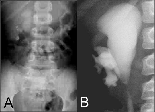 Figure 2 A) Pre-operative IVP in case 1; B)