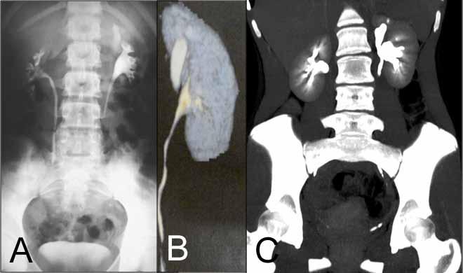Figure 5 A) Pre-operative IVP in case 4; B) Pre-operative CT reconstruction; and C) Post-operative CT 6 months after procedure. per moiety is to be preserved. According to Diaz- Ball et al.