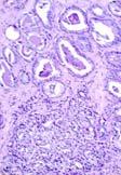 cell carcinoma Lymphoma PIN III Do NOT