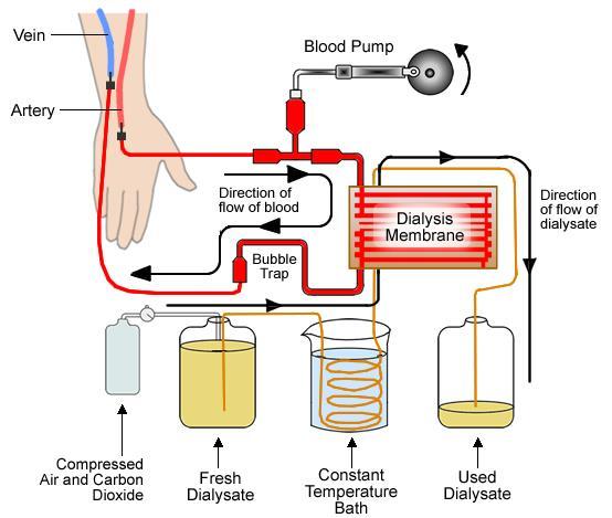 Dialysis - blood is removed and passed through a chamber with a