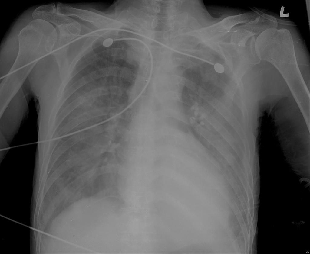 218 The Korean Journal of Critical Care Medicine: Vol. 29, No. 3, August 2014 Fig. 1. Initial portable chest X-ray (anteroposterior view) shows diffuse haziness in both lung fields. SaO 2 60.3%.