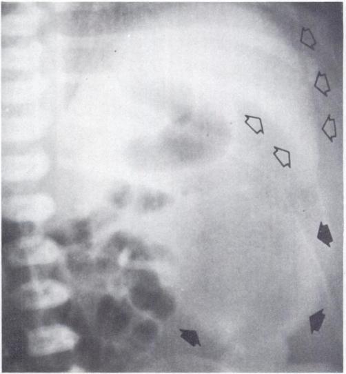 peritoneal fluid by total body opacification effect as well as by its inherent radiodensity.;5. - -. Fig 4 -Case 17.
