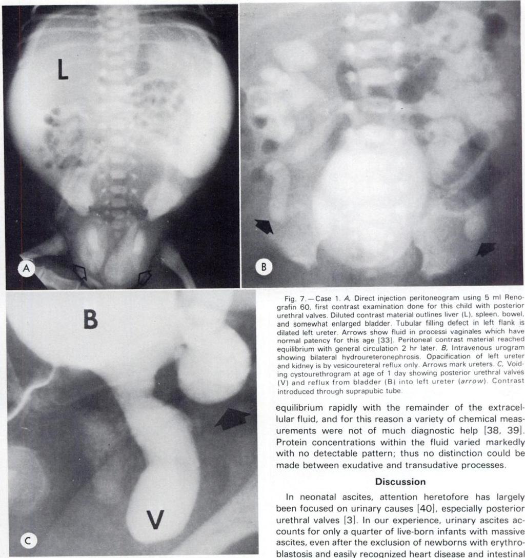 NEONATAL ASCITES 965 F I I, C.. were the gross appearance of the fluid and the presence or absence of white and red blood cells. In the four children with intestinal perforation (fig.