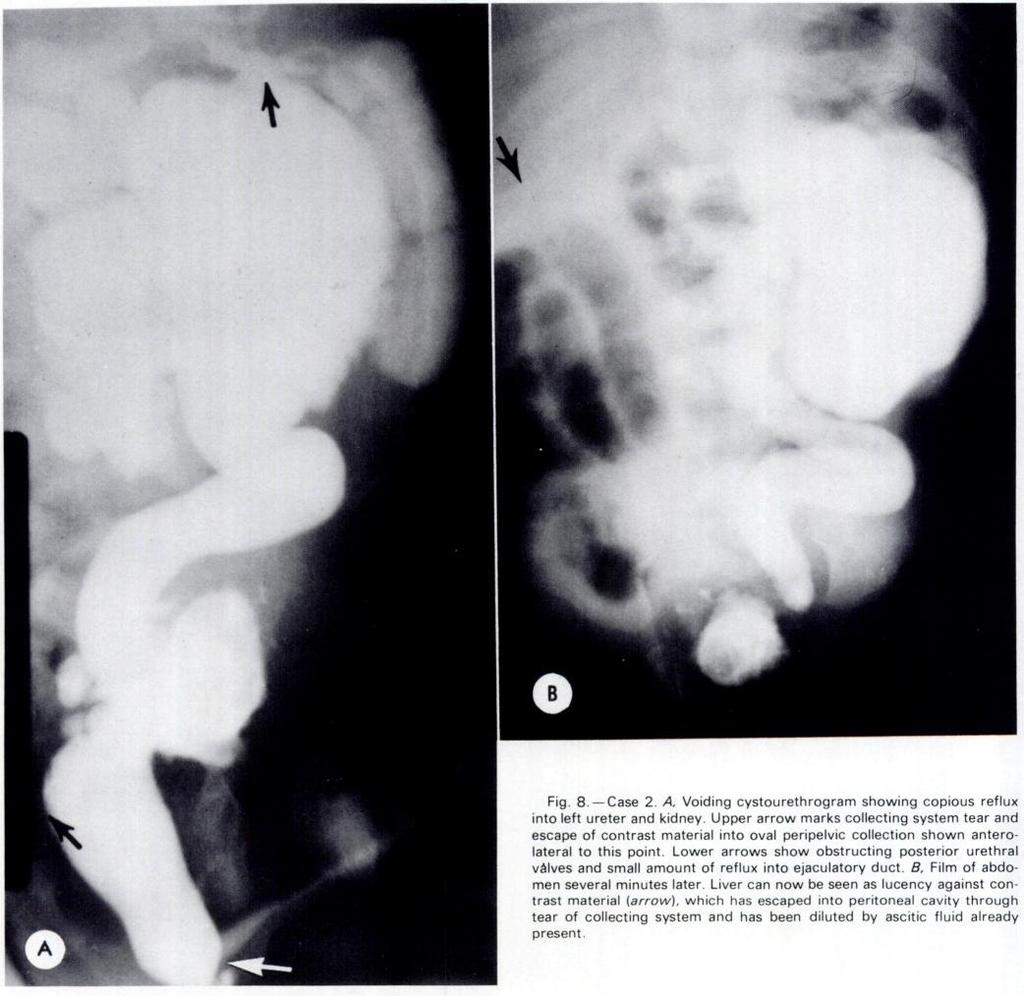 966 GRISCOM ET AL. urinary ascites due to this type of obstruction occurred in our series or was found in an incomplete review of the literature.