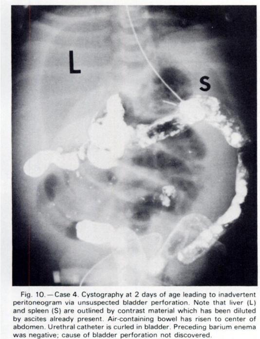 34] Pelvic neuroblastoma, bladder perforation [6. 36] Congenital nephrosis [43] Ureteric stenosis [44] Renal vein thrombosis [1 2.