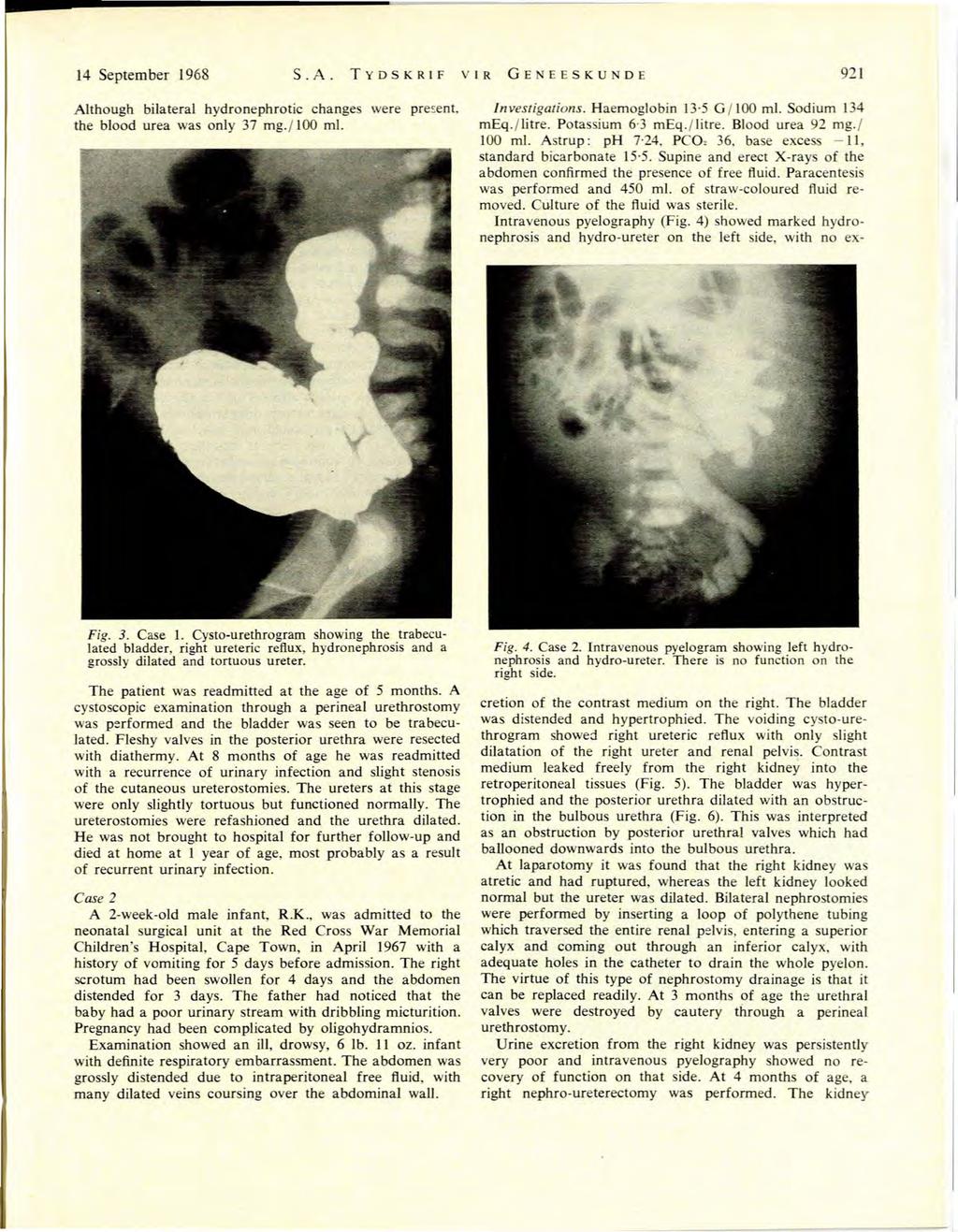 14 September 1968 S.A. TYDSKRF VR GENEESKUNDE 921 Although bilateral hydronephrotic changes were the blood urea was only 37 mg./100 ml. pre~ent, nvestigations. Haemoglobin 13 5 G /100 ml.