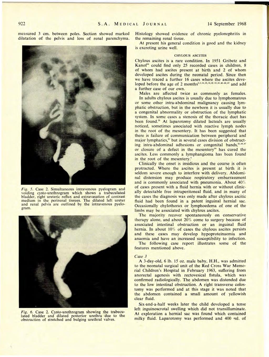 922 S.A. MEDCAL JOURNAL 14 September 1968 measured 3 cm. between poles. Section showed marked dilatation of the pelvis and loss of renal parenchyma. Fig. 5. Case 2.