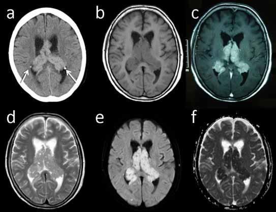 104 The Open Medical Imaging Journal, 2012, Volume 6 Oie et al. Fig. (1). The tumor symmetrically fills both lateral ventricles.