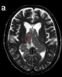 Primary Central Nervous System Lymphoma with Lateral Ventricle
