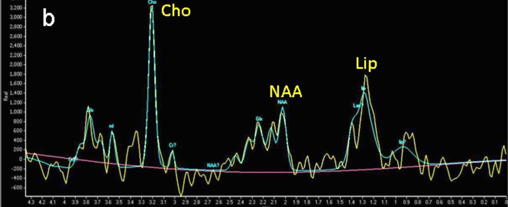 A lactate (Lac) peak is not visible.