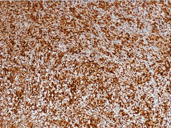 Figure 3. The lymphocytes were diffusely and strongly immunostained positive for CD30 ( 100). left frontal lobe with surrounding high-intensity area on T2-weighted images (Figure 1A and 1B).