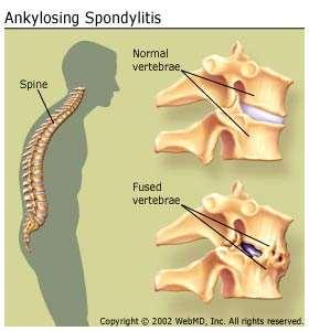 Ankylosing Spondylitis Spine Vertebrae fuse Signs/Symptoms Lower back