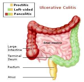Ulcerative Colitis Inflammatory bowel disease Lining of large intestine Types of UC: Proctitis Proctosigmoiditis