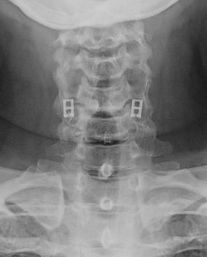 Patient Selection: Example 1 Cervical Fusion