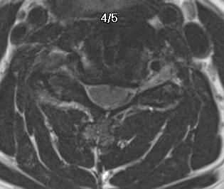 Adjacent Level Example 4 MRI